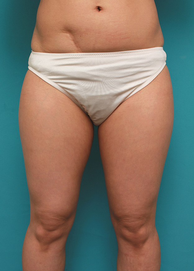 症例写真,イタリアン・メソシェイプ（イタリアンメソセラピー）・脂肪溶解注射で太もも全体を一回り細くした40代女性の症例写真,注射前,mainpic_meso038a.jpg