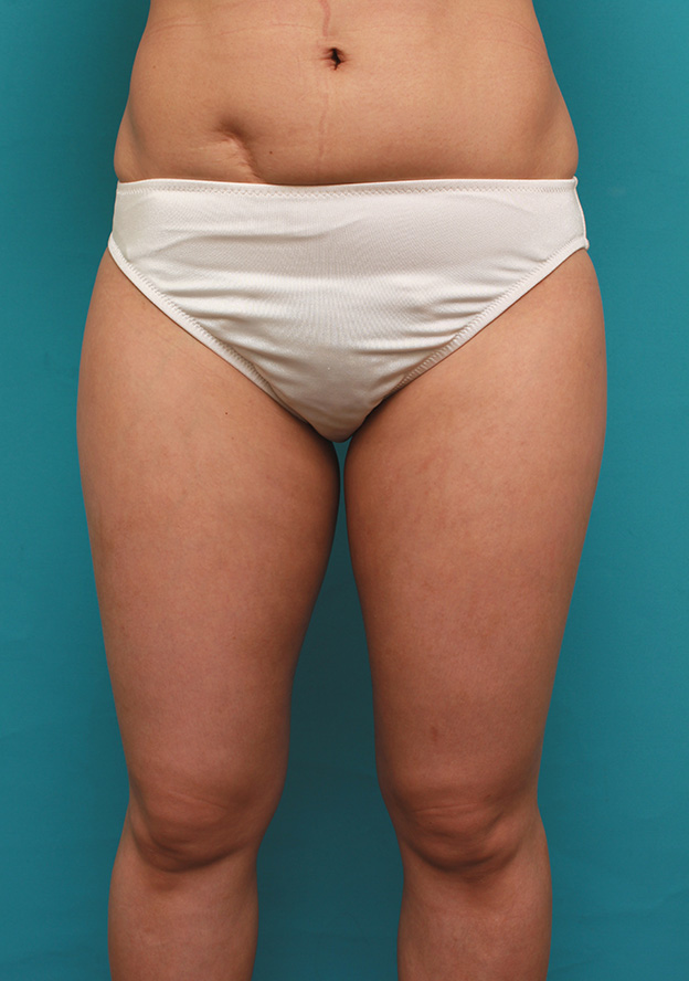 症例写真,イタリアン・メソシェイプ（イタリアンメソセラピー）・脂肪溶解注射で太もも全体を一回り細くした40代女性の症例写真,3回注射後1ヶ月,mainpic_meso038b.jpg