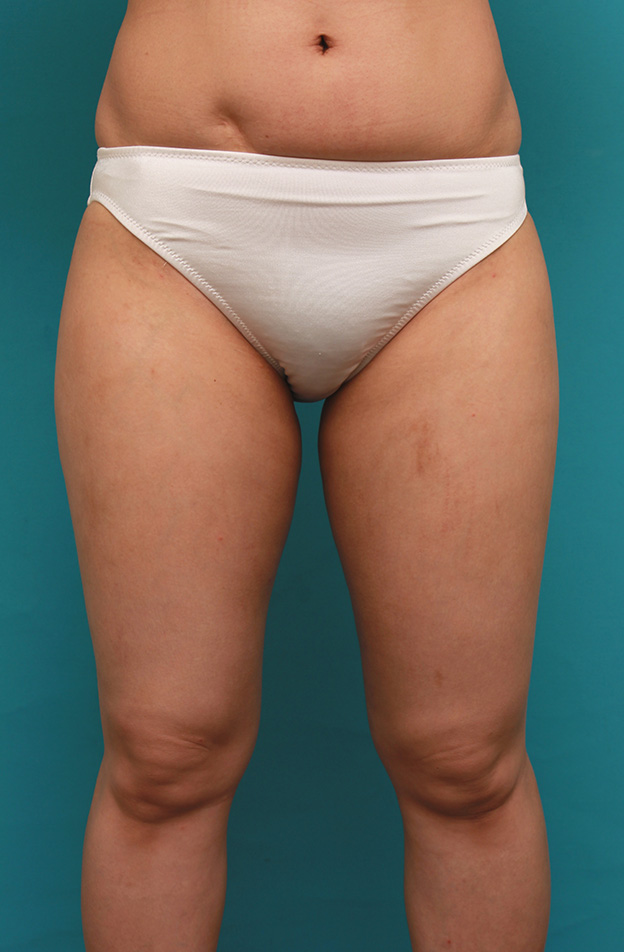 症例写真,イタリアン・メソシェイプ（イタリアンメソセラピー）・脂肪溶解注射で太もも全体を一回り細くした40代女性の症例写真,5回注射後1ヶ月,mainpic_meso038c.jpg