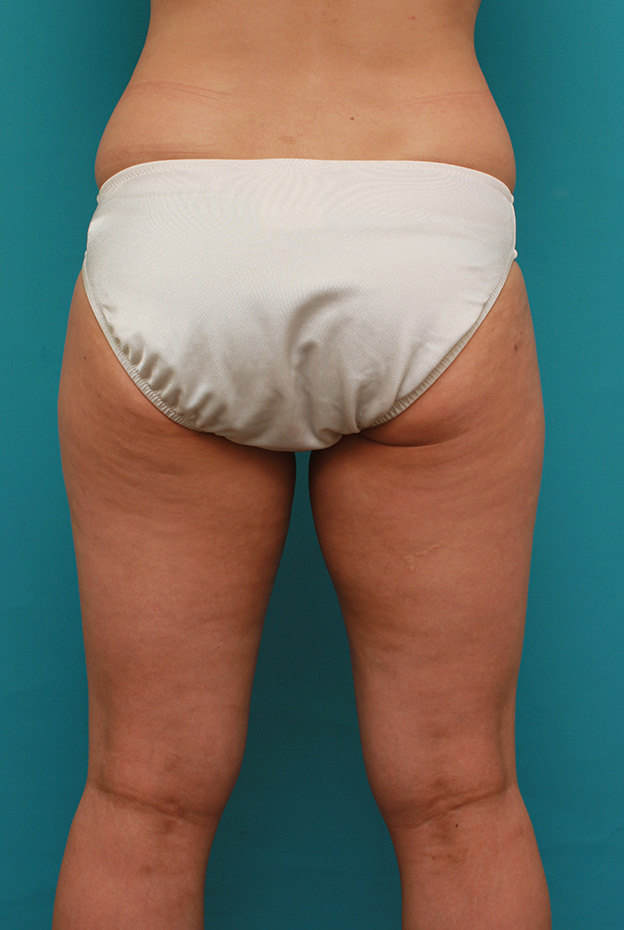 症例写真,イタリアン・メソシェイプ（イタリアンメソセラピー）・脂肪溶解注射で太もも全体を一回り細くした40代女性の症例写真,3回注射後1ヶ月,mainpic_meso038f.jpg