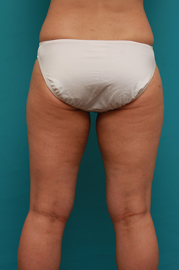 症例写真,イタリアン・メソシェイプ（イタリアンメソセラピー）・脂肪溶解注射で太もも全体を一回り細くした40代女性の症例写真,5回注射後1ヶ月,mainpic_meso038g.jpg