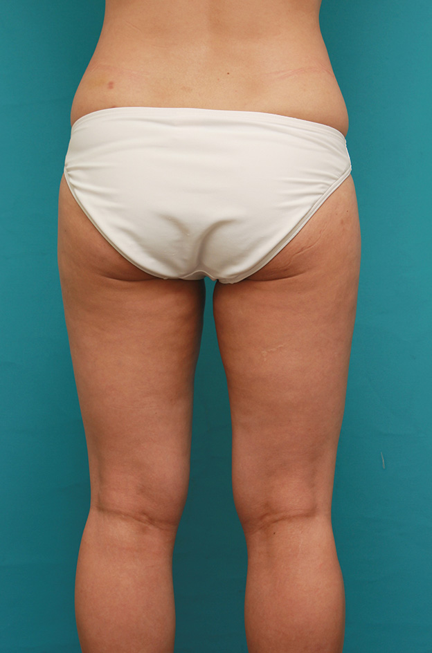 症例写真,イタリアン・メソシェイプ（イタリアンメソセラピー）・脂肪溶解注射で太もも全体を一回り細くした40代女性の症例写真,6回注射後2ヶ月,mainpic_meso038h.jpg