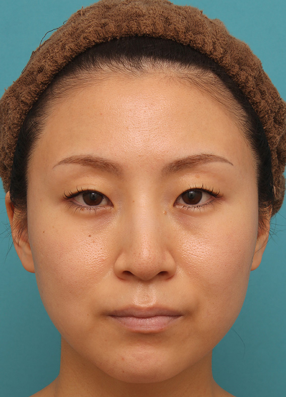 イタリアンリフトを施した30代女性の症例写真,Before,ba_italian019_b01.jpg