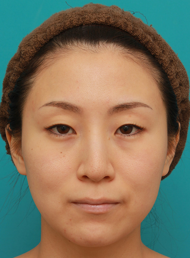 症例写真,イタリアンリフトを施した30代女性の症例写真,1週間後,mainpic_italian019c.jpg
