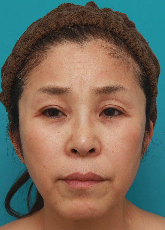 こめかみリフトと上まぶたたるみ取り手術で顔の上半分をエイジングケアした50代女性の症例写真,After,ba_komekamilift003_a01.jpg