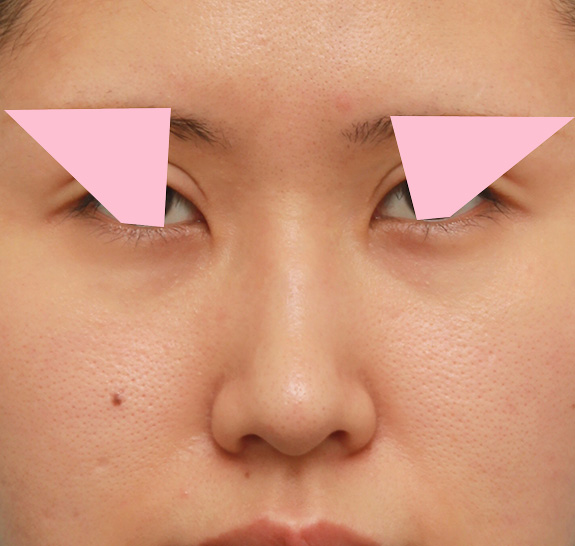症例写真,鼻の穴の内側から外側の途中にかけて切除するデザインで小鼻縮小した症例写真,After（6ヶ月後）,ba_biyoku042_b01.jpg