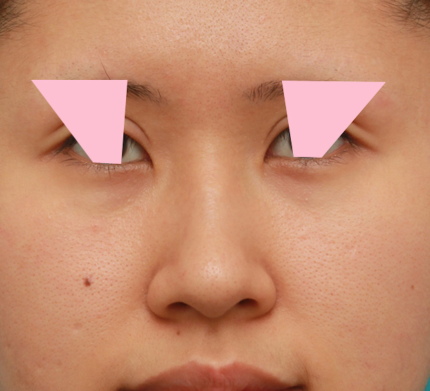 症例写真,鼻の穴の内側から外側の途中にかけて切除するデザインで小鼻縮小した症例写真,手術前,mainpic_biyoku042a.jpg