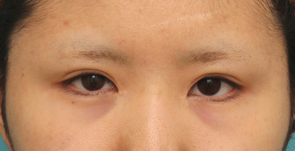 症例写真,他院で目頭切開を受けた後、蒙古襞形成で修正手術した症例写真,After（6ヶ月後）,ba_hida008_b01.jpg