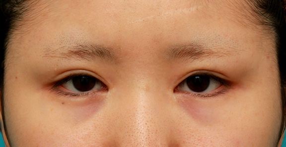 他院で目頭切開を受けた後、蒙古襞形成で修正手術した症例写真,Before,ba_hida008_b01.jpg