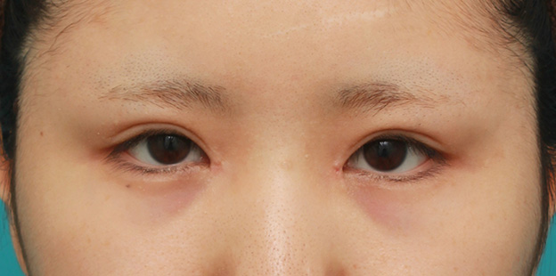症例写真,他院で目頭切開を受けた後、蒙古襞形成で修正手術した症例写真,1週間後,mainpic_hida008c.jpg