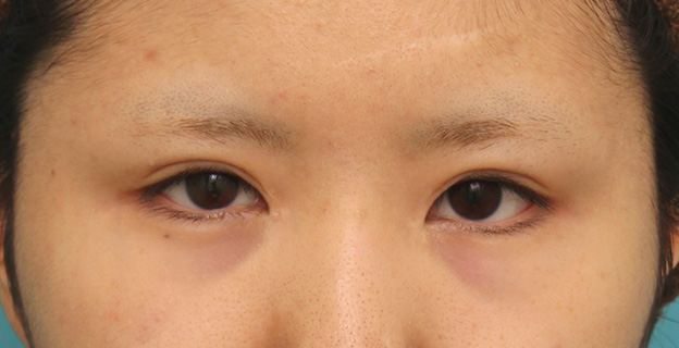 症例写真,他院で目頭切開を受けた後、蒙古襞形成で修正手術した症例写真,6ヶ月後,mainpic_hida008f.jpg