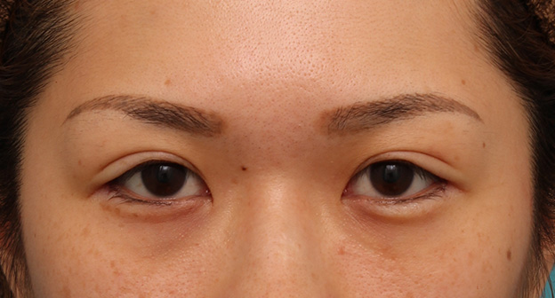症例写真,目尻切開で目を外側に大きくした20代女性の症例写真,手術直後,mainpic_mejiri015b.jpg