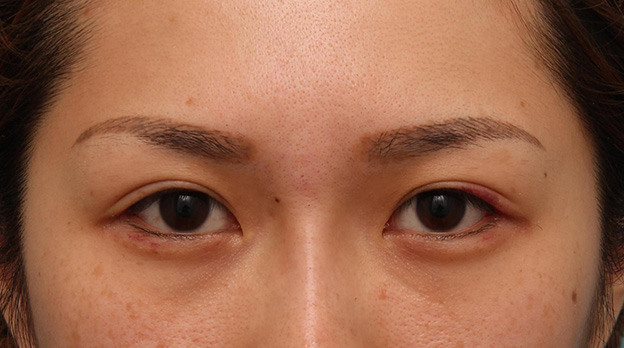 症例写真,目尻切開で目を外側に大きくした20代女性の症例写真,1週間後,mainpic_mejiri015c.jpg