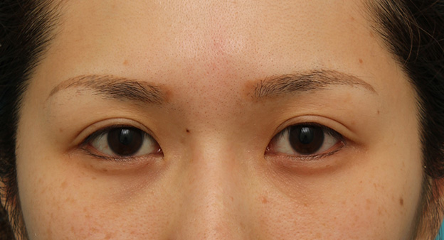 症例写真,目尻切開で目を外側に大きくした20代女性の症例写真,1ヶ月後,mainpic_mejiri015d.jpg