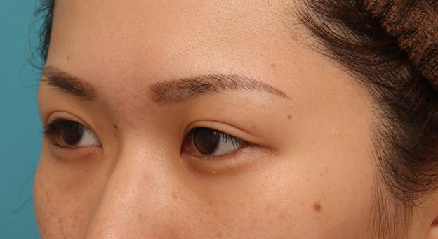 症例写真,目尻切開で目を外側に大きくした20代女性の症例写真,手術前,mainpic_mejiri015f.jpg
