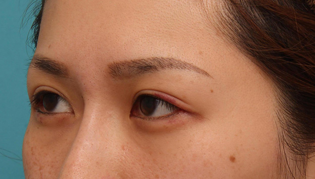 症例写真,目尻切開で目を外側に大きくした20代女性の症例写真,1週間後,mainpic_mejiri015h.jpg