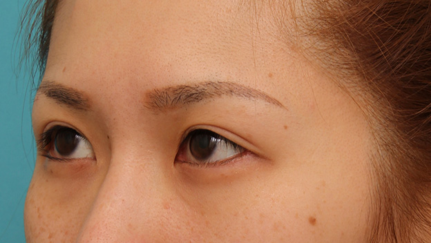 症例写真,目尻切開で目を外側に大きくした20代女性の症例写真,6ヶ月後,mainpic_mejiri015j.jpg