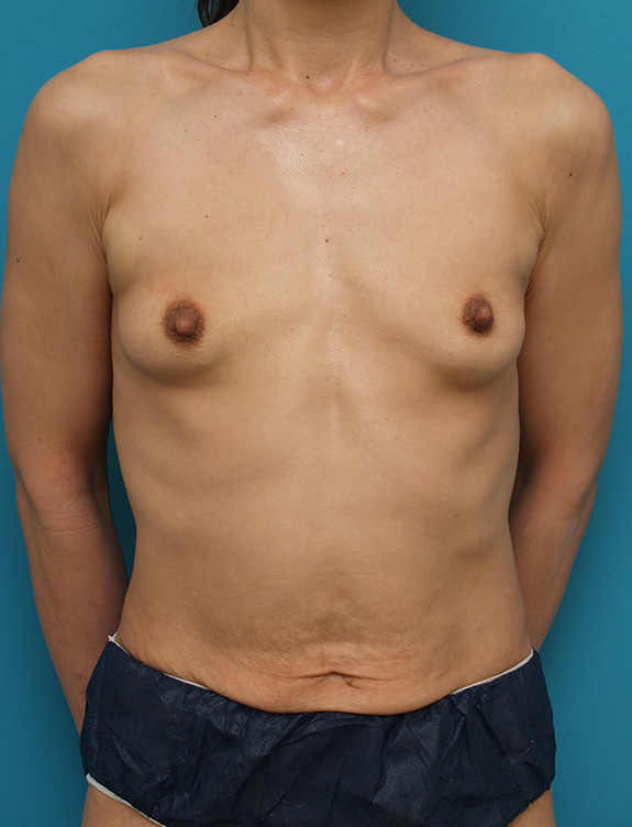 症例写真,大胸筋下の生理食塩水バッグプロテーゼを抜いた症例写真,After（生理食塩水バッグ<br/>
プロテーゼ除去手術後）,ba_prosthesis_removal005_b01.jpg