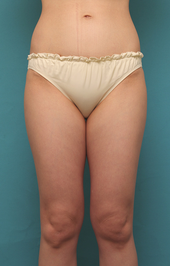 太ももをイタリアン・メソシェイプ（イタリアンメソセラピー）・脂肪溶解注射で細くした20代女性の症例写真,After（1クール治療後）,ba_meso039_a01.jpg