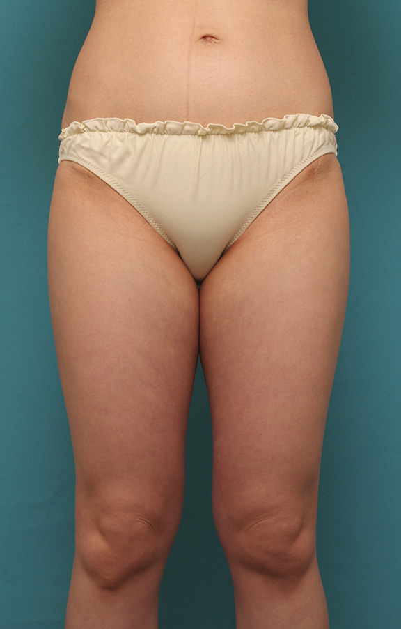 太ももをイタリアン・メソシェイプ（イタリアンメソセラピー）・脂肪溶解注射で細くした20代女性の症例写真,Before,ba_meso039_b01.jpg