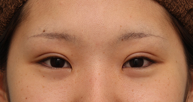 症例写真,二重まぶた全切開法で、一番自然な幅よりもやや幅を広くして平行型二重にした症例写真,3週間後,mainpic_sekkai051d.jpg