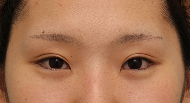 症例写真,二重まぶた全切開法で、一番自然な幅よりもやや幅を広くして平行型二重にした症例写真,6ヶ月後,メイクなし,mainpic_sekkai051e.jpg