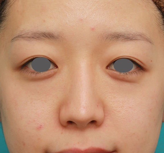 症例写真,鼻シリコンプロテーゼ＋鼻先の耳介軟骨移植＋小鼻縮小の症例写真,After（7ヶ月後）,ba_ryubi1041_b01.jpg