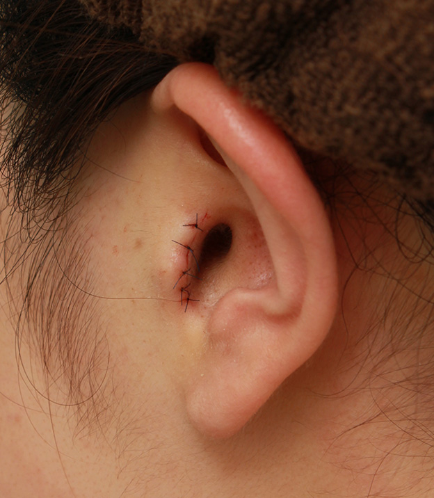 耳介軟骨移植（鼻先を出す）,鼻シリコンプロテーゼ＋鼻先の耳介軟骨移植＋小鼻縮小の症例写真,手術直後,mainpic_ryubi1041f.jpg