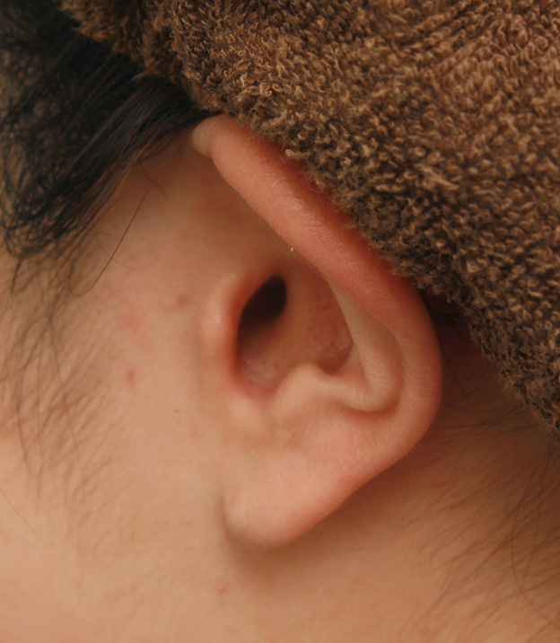 症例写真,鼻シリコンプロテーゼ＋鼻先の耳介軟骨移植＋小鼻縮小の症例写真,7ヶ月後,mainpic_ryubi1041h.jpg