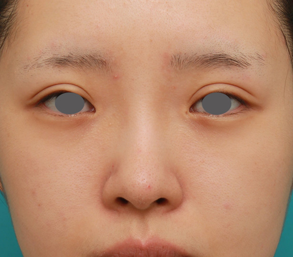 症例写真,のっぺりした平らな顔に3.5mmのI型シリコンプロテーゼを入れ、自然に鼻筋を通した症例写真,After（6ヶ月後）,ba_ryubi1042_b01.jpg