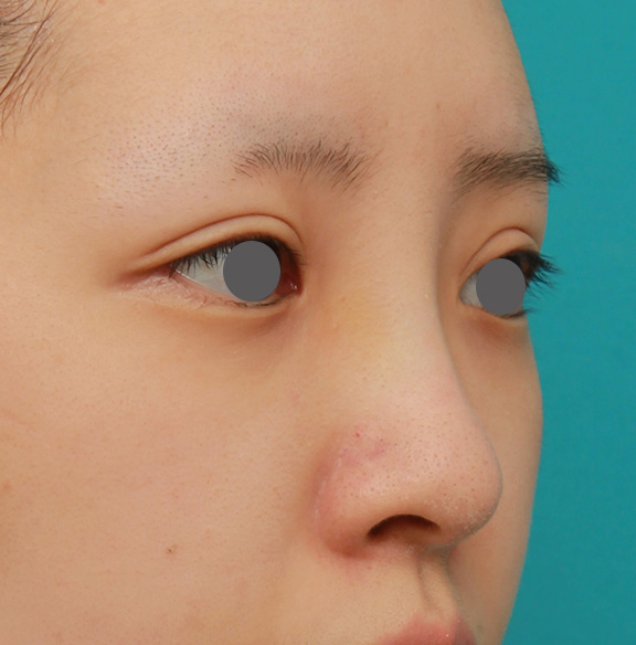 症例写真,のっぺりした平らな顔に3.5mmのI型シリコンプロテーゼを入れ、自然に鼻筋を通した症例写真,After（6ヶ月後）,ba_ryubi1042_b02.jpg