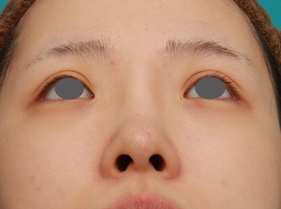 症例写真,のっぺりした平らな顔に3.5mmのI型シリコンプロテーゼを入れ、自然に鼻筋を通した症例写真,After（6ヶ月後）,ba_ryubi1042_b04.jpg
