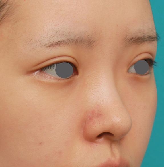 症例写真,のっぺりした平らな顔に3.5mmのI型シリコンプロテーゼを入れ、自然に鼻筋を通した症例写真,Before,ba_ryubi1042_b02.jpg