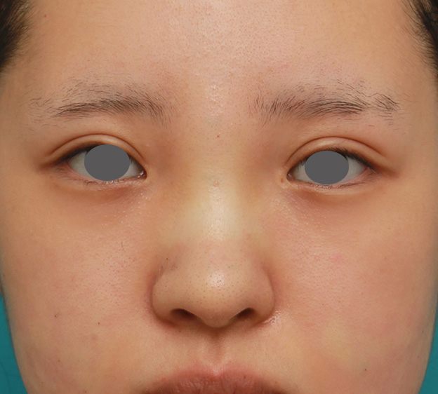 症例写真,のっぺりした平らな顔に3.5mmのI型シリコンプロテーゼを入れ、自然に鼻筋を通した症例写真,手術直後,mainpic_ryubi1042b.jpg