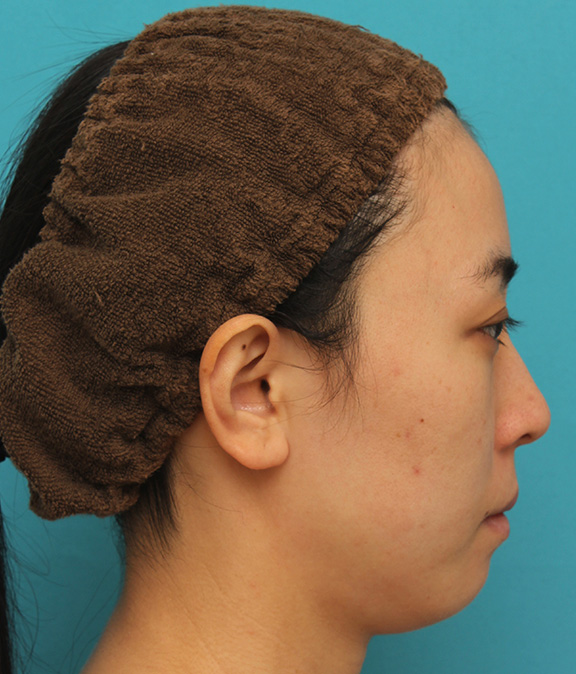 症例写真,顔と首にウルセラシステムを行い、リフトアップと引き締め効果を出した20代後半女性の症例写真,Before,ba_ulthera018_b02.jpg