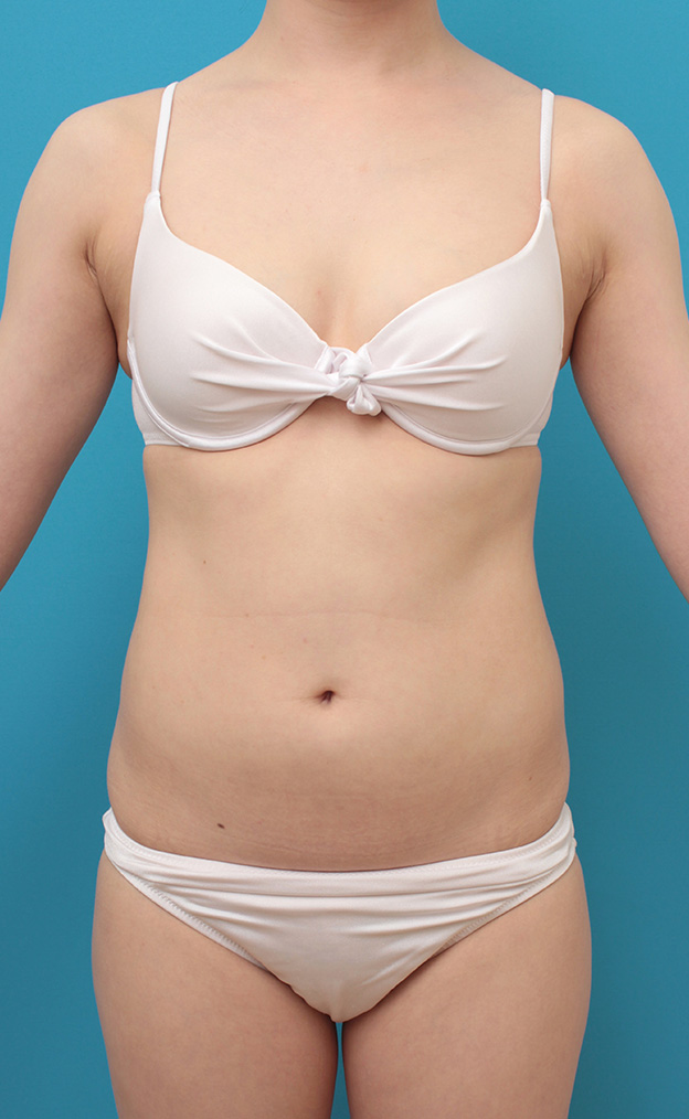 症例写真,お腹周りにイタリアン・メソシェイプ（イタリアンメソセラピー）・脂肪溶解注射を行い、一回り細くした20代女性の症例写真,来院時,mainpic_meso040a.jpg