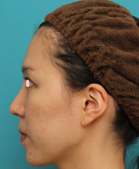 症例写真,ハンプ切除+鼻骨切り幅寄せ手術を行った20代女性の症例写真,After（6ヶ月後）,ba_hump011_b03.jpg