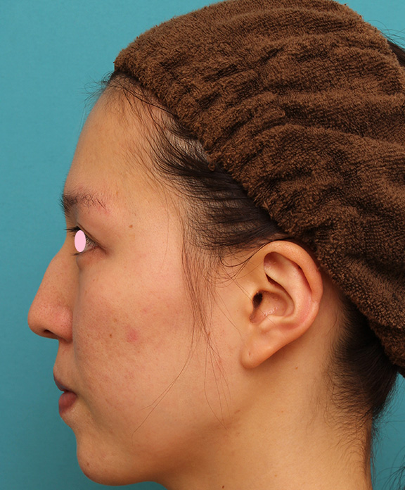 症例写真,ハンプ切除+鼻骨切り幅寄せ手術を行った20代女性の症例写真,Before,ba_hump011_b03.jpg