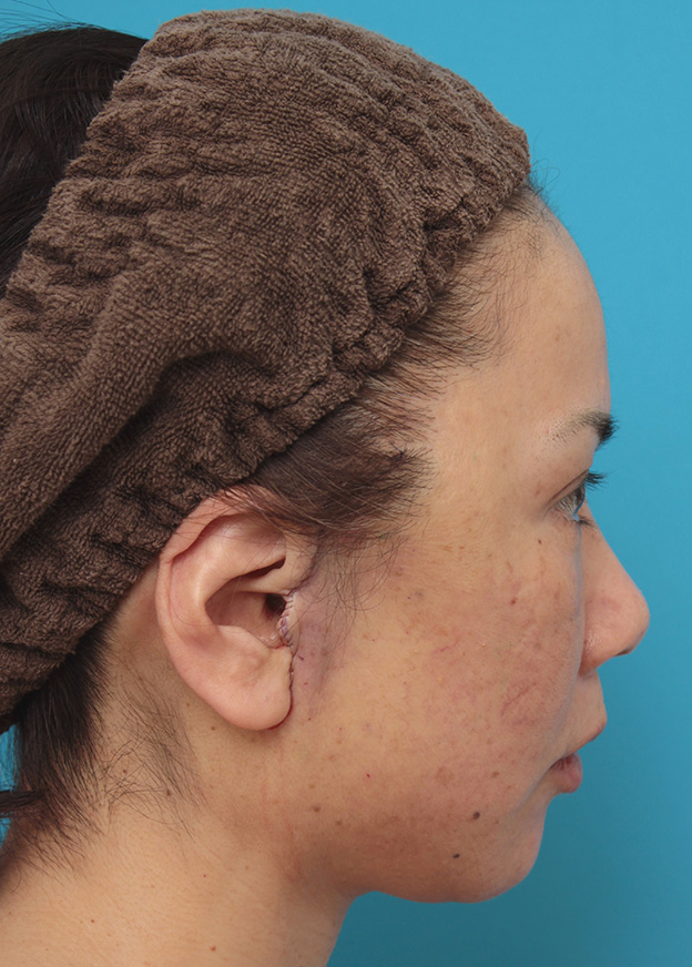 症例写真,ミニフェイスリフト（頬のたるみ取り）で頬のたるみがリフトアップした50代女性の症例写真,手術直後,mainpic_minilift005f.jpg
