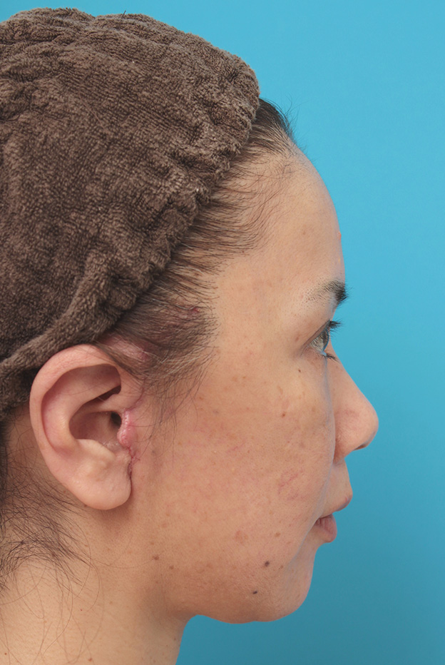 症例写真,ミニフェイスリフト（頬のたるみ取り）で頬のたるみがリフトアップした50代女性の症例写真,1週間後,mainpic_minilift005g.jpg
