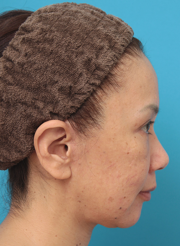 症例写真,ミニフェイスリフト（頬のたるみ取り）で頬のたるみがリフトアップした50代女性の症例写真,6ヶ月後,mainpic_minilift005h.jpg