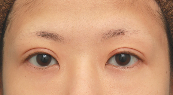 症例写真,眼瞼下垂手術で幅広平行型二重を作った症例写真,After（4ヶ月後）,ba_ganken035_b01.jpg