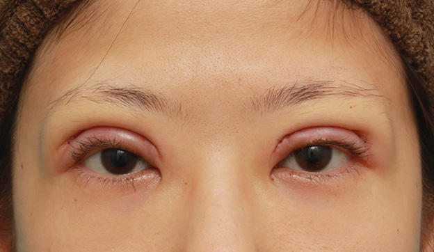 症例写真,眼瞼下垂手術で幅広平行型二重を作った症例写真,手術直後,mainpic_ganken035b.jpg