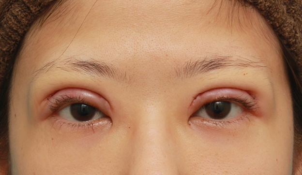 症例写真,眼瞼下垂（がんけんかすい）の症例写真 眼瞼下垂手術＋二重まぶた全切開法,手術直後,mainpic_ganken035b.jpg