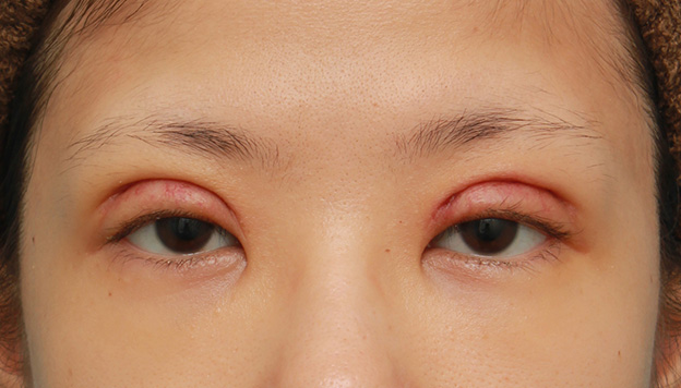 症例写真,眼瞼下垂手術で幅広平行型二重を作った症例写真,1週間後,mainpic_ganken035c.jpg