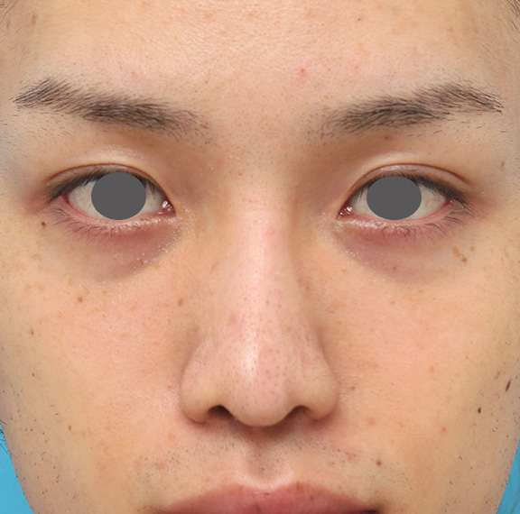 症例写真,5mmのI型シリコンプロテーゼを鼻に入れて高くし、鼻筋を通した症例写真,After(6ヶ月後),ba_ryubi1043_b01.jpg