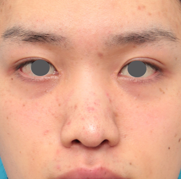 症例写真,5mmのI型シリコンプロテーゼを鼻に入れて高くし、鼻筋を通した症例写真,Before,ba_ryubi1043_b01.jpg