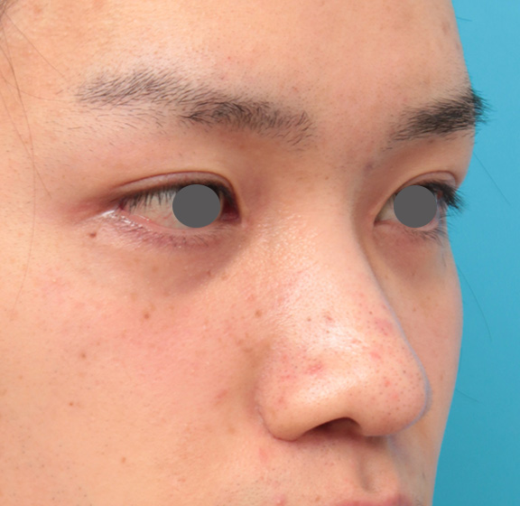 症例写真,5mmのI型シリコンプロテーゼを鼻に入れて高くし、鼻筋を通した症例写真,Before,ba_ryubi1043_b02.jpg