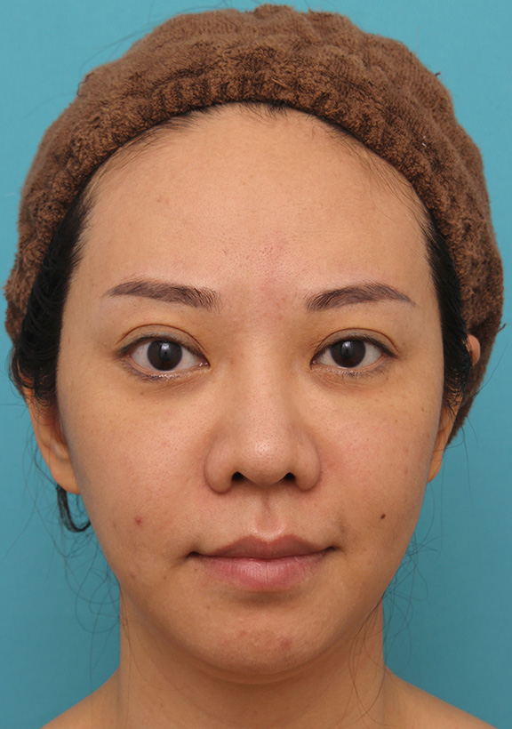 ウルセラシステム,ウルセラシステムで顔と顎下のたるみを引き締めた30代後半女性の症例写真,After（3ヶ月後）,ba_ulthera019_a01.jpg