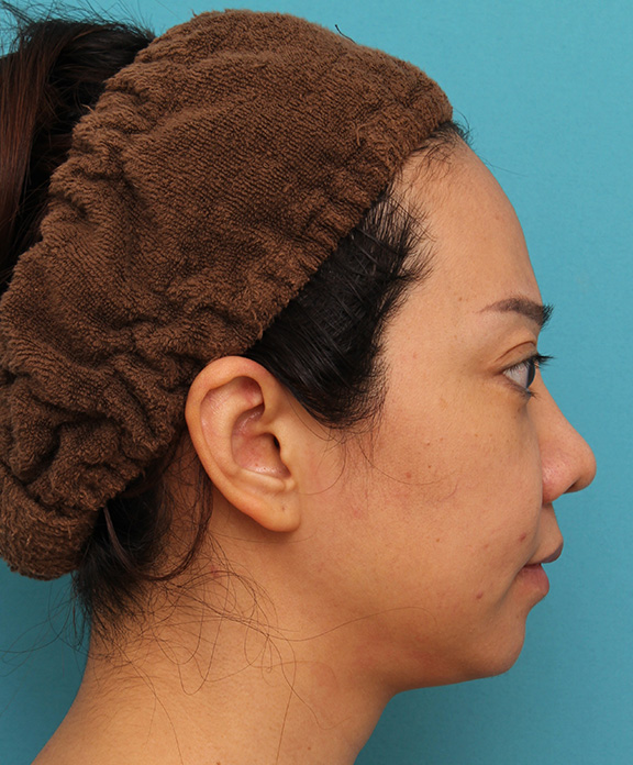ウルセラシステム,ウルセラシステムで顔と顎下のたるみを引き締めた30代後半女性の症例写真,After（3ヶ月後）,ba_ulthera019_b02.jpg